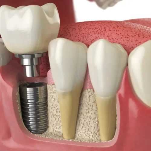 Are Dental Implants A Good Idea?